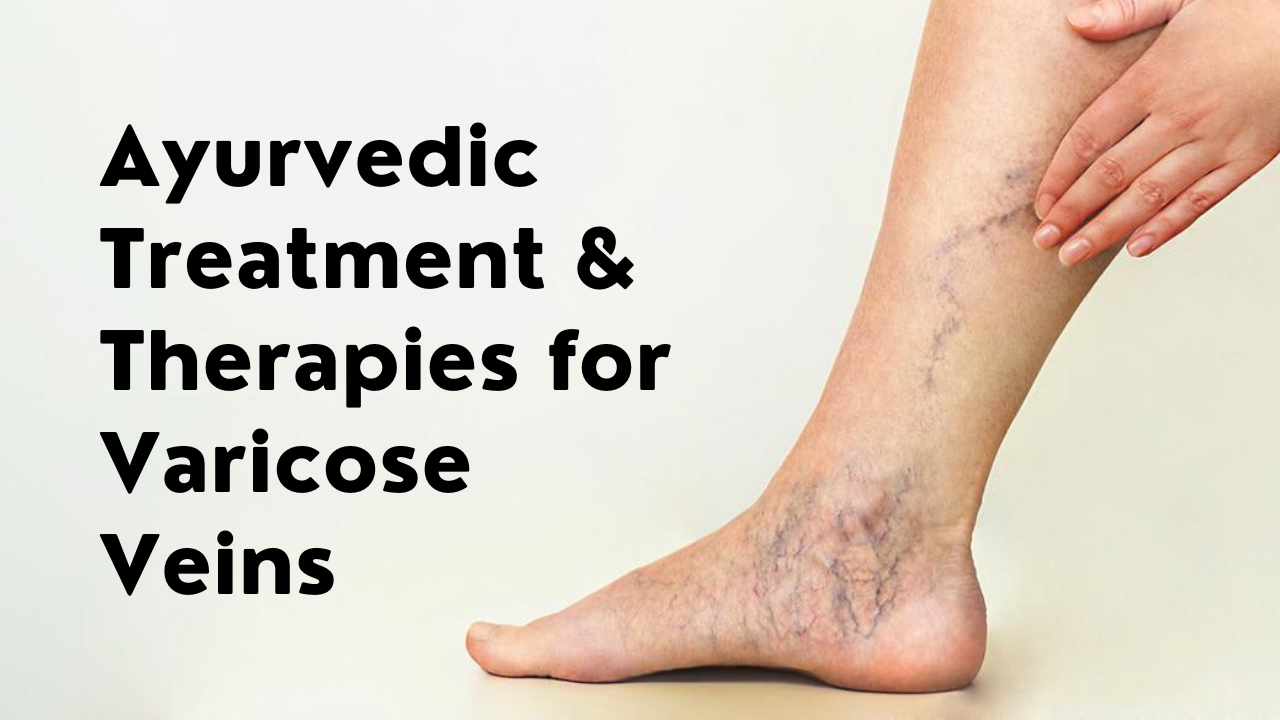 Ayurvedic Treatment & Therapies for Varicose Veins Prakritiveda