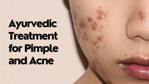 Ayurvedic Treatment for Pimple and Acne